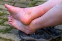 Swollen, sore feet of a pilgrim at Puente La Reina a Basque town along the Way of St. James pilgrimage route, Navarra, Spain.